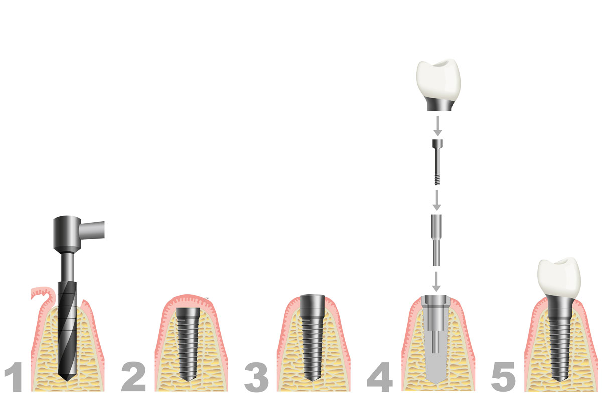 BAUTEILE DES IMPLANTATS