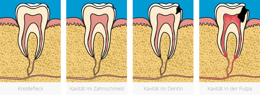 Kariesstadien